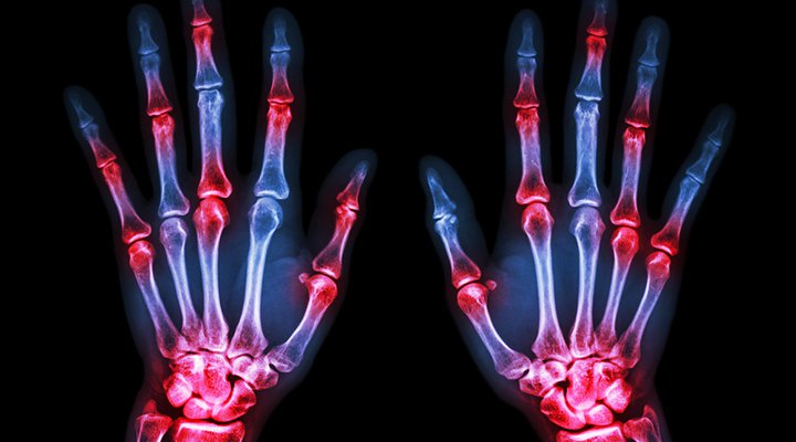 Rheumatoid Arthritis FindMeCure Clinical Trials